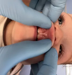 Infant with a lip tie
