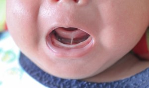 Infant with a tongue tie